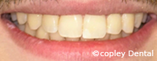 CASE 52: Fractured Tooth - After