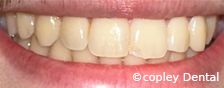 CASE 52: Fractured Tooth - Before