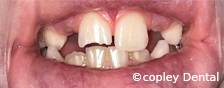 CASE 53: Fractured Tooth - Before