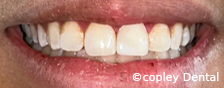 CASE 54: Fractured Tooth - After