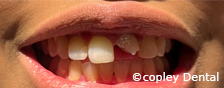 CASE 54: Fractured Tooth - Before