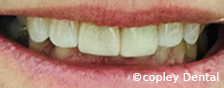 CASE 55: Fractured Tooth - After