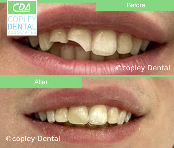 CASE 56: Fractured Tooth