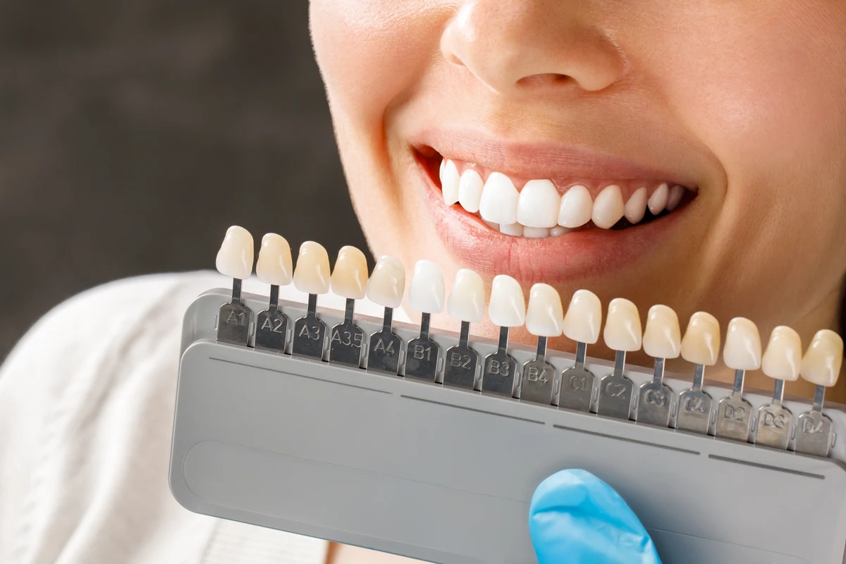 Porcelain Dental Veneers