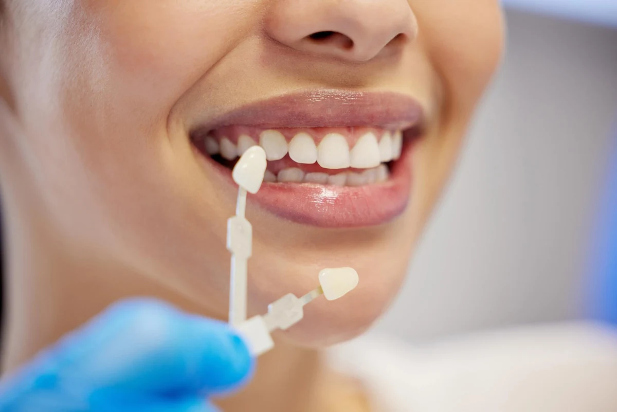 Lumineers Ultra-Thin Veneers