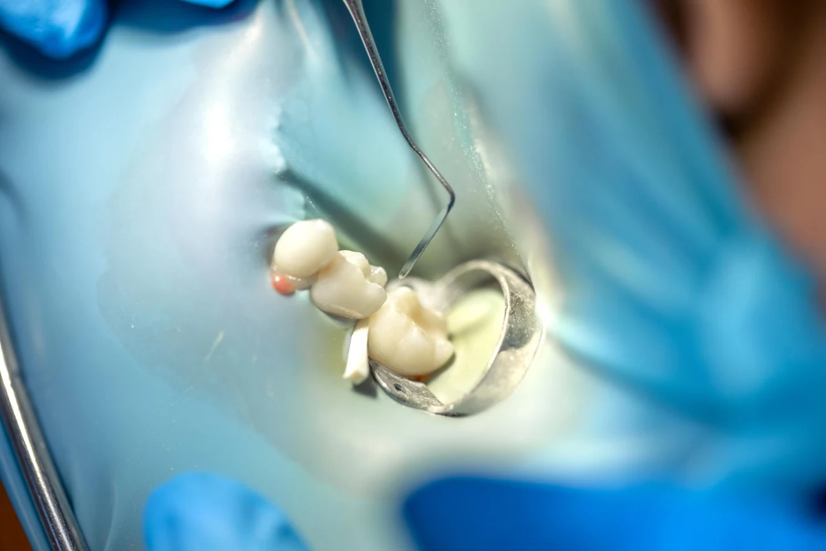 Root Canal Treatment