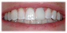 CASE 13: Emergency Treatment – Fractured Tooth - After