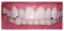 CASE 17: Emergency Treatment – Broken Teeth - After