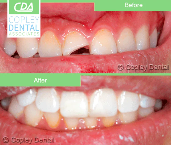 CASE 28: Broken Fractured Tooth
