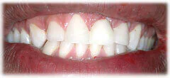 CASE 34: Emergency Treatment – Fractured Tooth - After