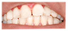 CASE 41: Emergency Treatment – Fractured Tooth - After