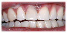 CASE 7: Emergency Treatment – Fractured Tooth - After