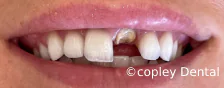 CASE 46: Emergency Treatment – Fractured Tooth