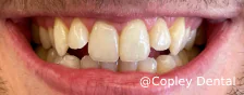 CASE 48: Fractured Tooth - After