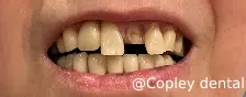 CASE 51: Emergency Visit – Fractured Tooth